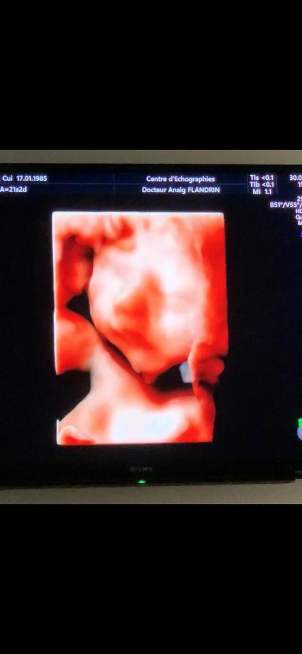孕十三周胎儿真实图男女区别（十三周胎儿能看出男女吗）