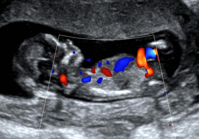 早期男宝女宝孕晚期男女宝b超图片区别超图区别（孕晚期男女宝b超图片区别）