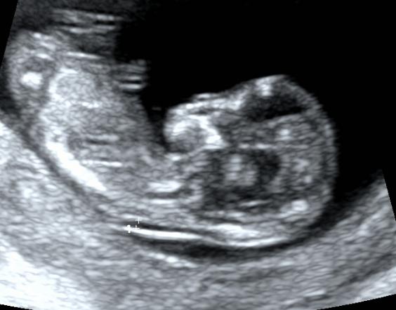 怀孕三个月男胎儿图片大全（怀孕3个月男胎儿图）
