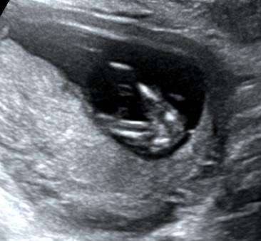 怀孕三个月男胎儿图片大全（怀孕3个月男胎儿图）